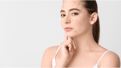 Can’t Get Rid of Acne? The Culprit Could Be Your Gut…